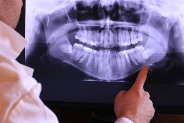 Best Emergency Root Canal Treatment in Poughkeepsie, NY